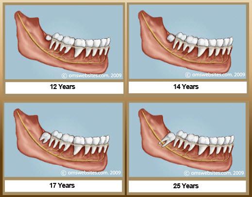 Wisdom Teeth Extraction Services Melbourne